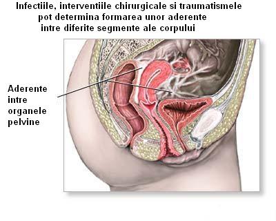 Boala inflamatorie pelvina si infertilitatea