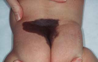 Nevus gigant congenital