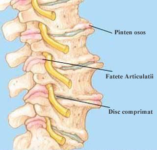 Osteoartrita