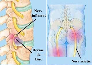 Hernia de disc