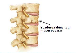 Osteoporoza