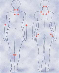 Fibromialgia