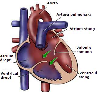 Defectul canalului atrioventricular