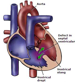 Defect de sept ventricular