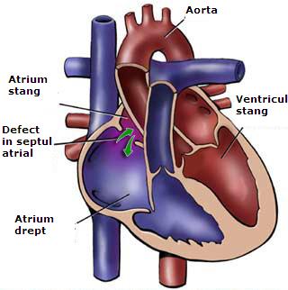  Defect de sept atrial