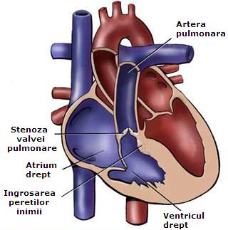 Stenoza valvulei pulmonare