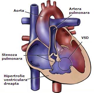 Tetralogia Fallot